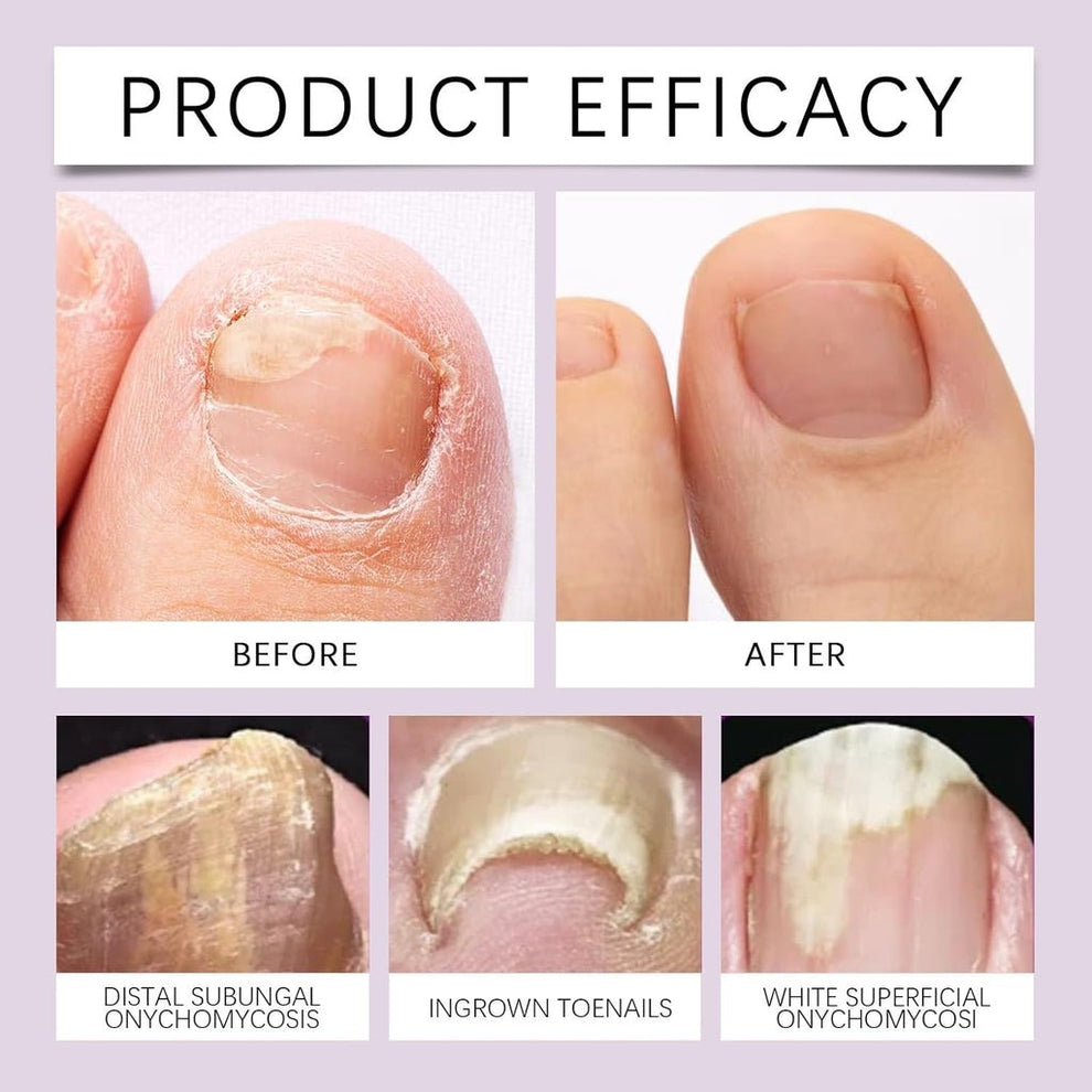 Fungi Free Bee Venom Nail Treatment Solution Serum (15ml) Buy 1 Get 1 Free